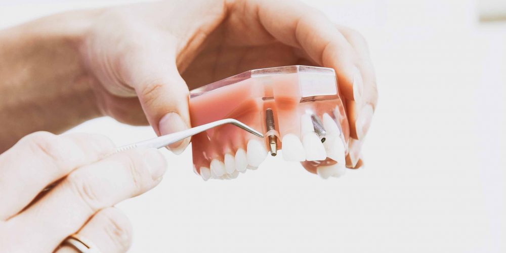 peter-kasprzyk-110926 (1) implantologia dentale