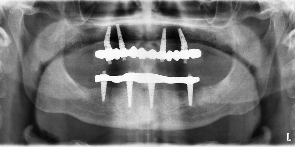 all on four implantologia dentale