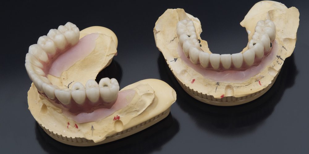 impianti implantologia dentale